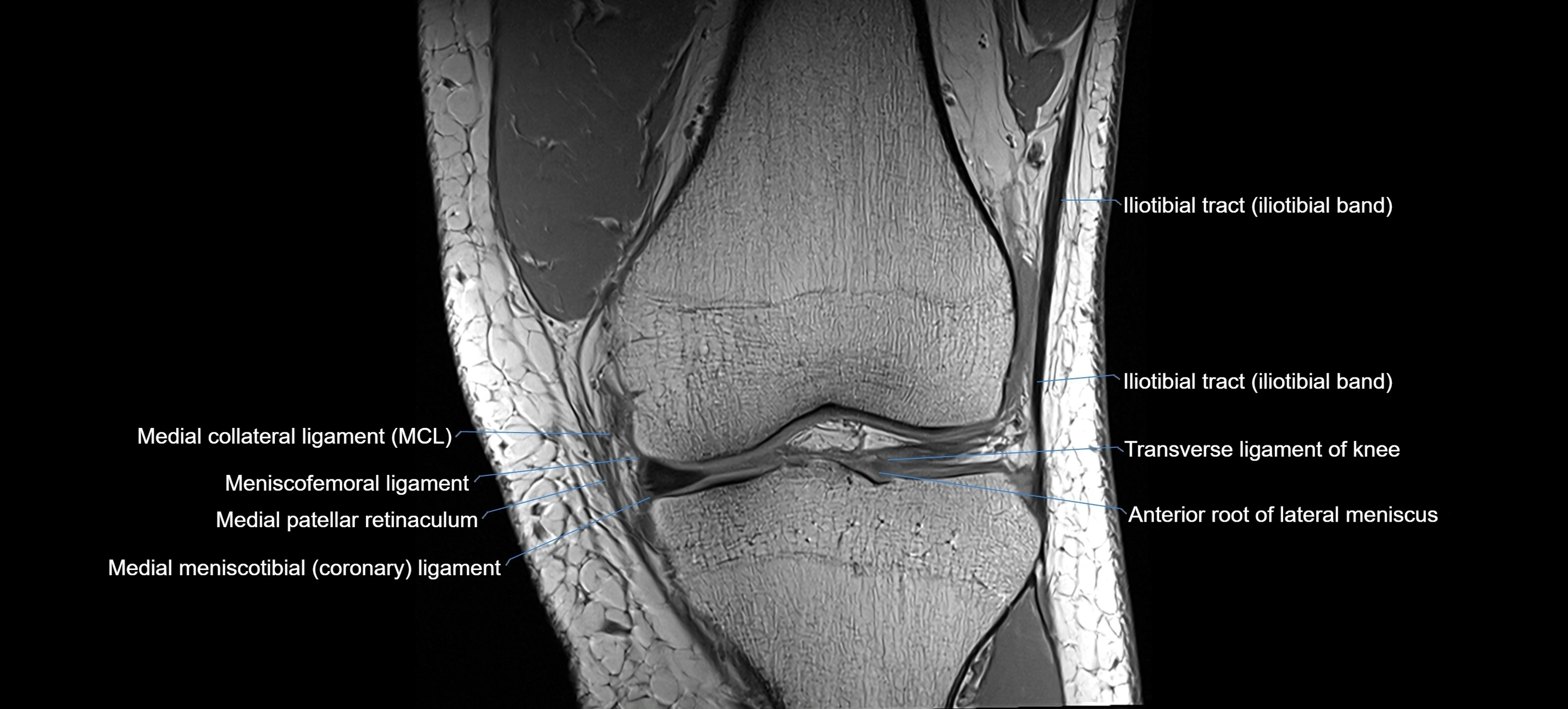 MRI coronal  ligaments cross sectional anatomy 3T  radiology  image-img-04001-00016.webp